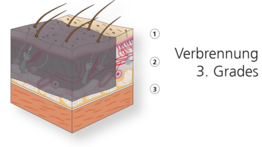 4 5 Verbrennungen Verbr hungen Erfrierungen Ligamed Medical 4-5-verbrennungen-verbr-hungen-erfrierungen-ligamed-medical